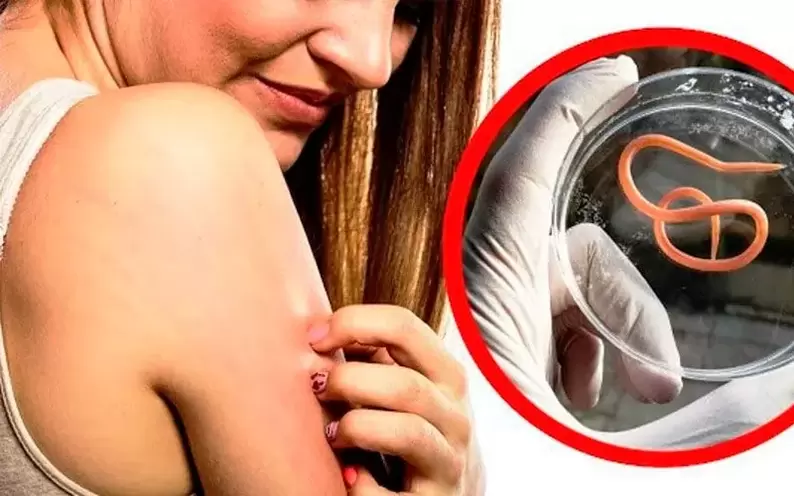 อาการคันและระคายเคืองเนื่องจากปรสิตในร่างกาย